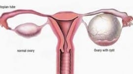 Κύστες ωοθήκης: Λαπαροσκοπική αφαίρεση