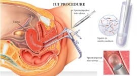 Ενδομητρική σπερματέγχυση- Intrauterine insemination (ΙUI)
