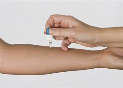 Αλλεργική ρινίτιδα: Πως γίνετε η διάγνωση με skin prick tests & πώς αντιμετωπίζετε αποτελεσματικά